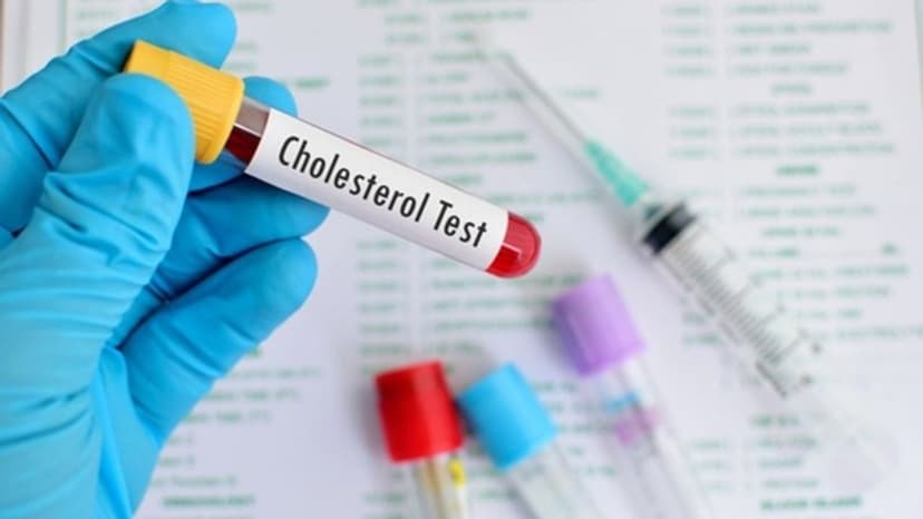 Giải đáp các thắc mắc thường gặp về xét nghiệm mỡ máu