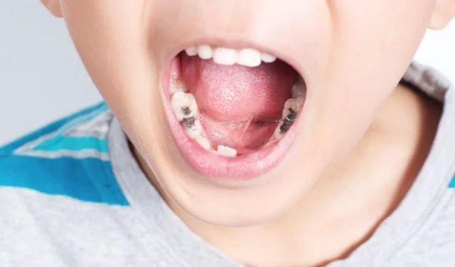 7 Dấu hiệu sâu răng ở trẻ mà cha mẹ cần biết