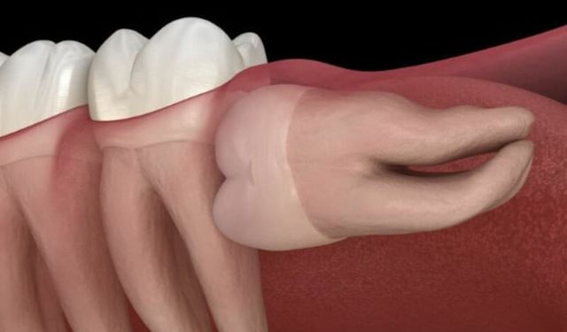 Mọc răng số 8 bị đau: Nguyên nhân và cách giảm đau hiệu quả
