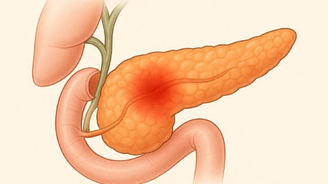 Điều trị viêm tụy cấp: Cẩm nang hiệu quả cho người bệnh