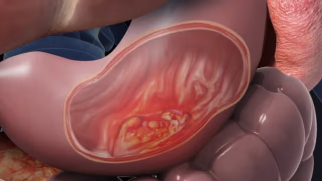 Các dấu hiệu ung thư dạ dày điển hình