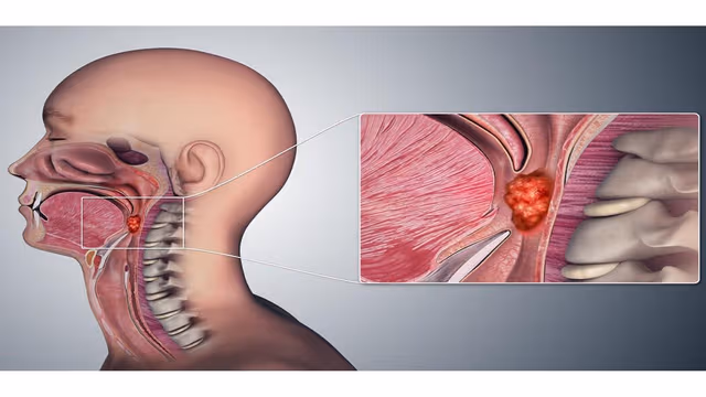Bệnh ung thư vòm họng có lây không?