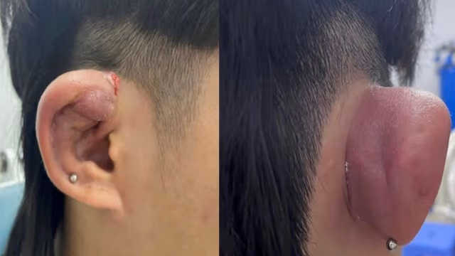 Áp xe tai là gì? Các vị trí áp dễ bị và vì sao cần điều trị sớm?