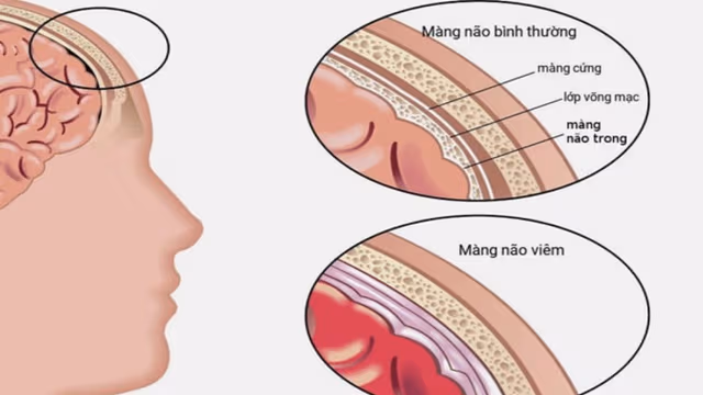 Liều Ceftriaxone viêm màng não