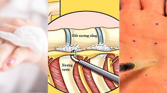 Các phương pháp điều trị tăng tiết mồ hôi: Lựa chọn nào phù hợp?