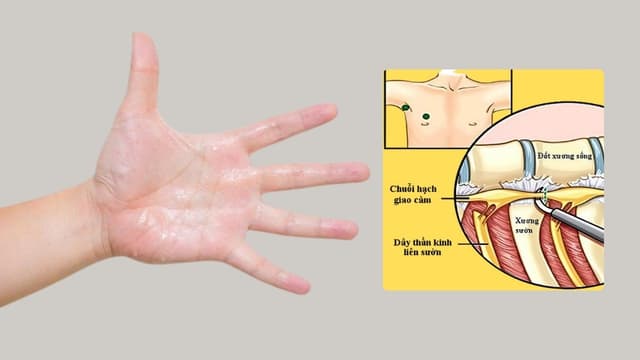 Hạch giao cảm là gì? Vai trò và mối liên hệ với tăng tiết mồ hôi
