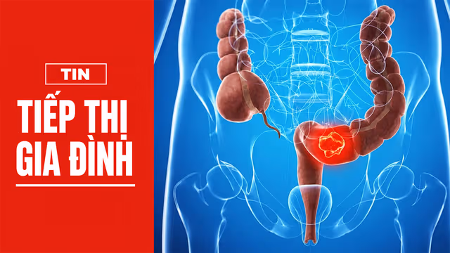Từ polyp đến ung thư: Hành trình 10 năm có thể ngăn chặn