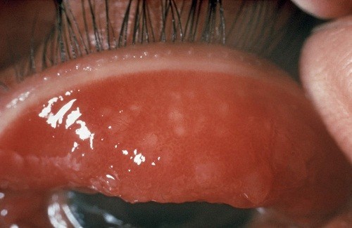 Tất cả các dấu hiệu của bệnh đau mắt hột ở mi mắt trên thường nghiêm trọng hơn so với mi dưới. 
