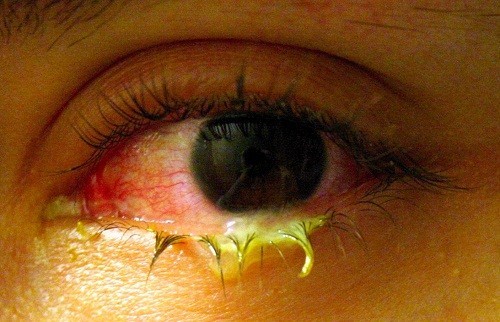 Ngứa, chảy nước mắt, chất nhầy hoặc mủ là các triệu chứng đầu tiên của bệnh đau mắt hột.