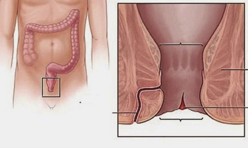 phẫu thuật nứt kẽ hậu môn