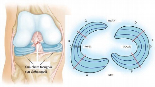 Rách sụn chêm cần được điều trị đúng cách