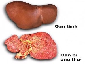 Các bệnh lí về gan nếu không được phát hiện sớm và điều trị kịp thời có thể gây ra những biến chứng nguy hiểm (ảnh minh họa).