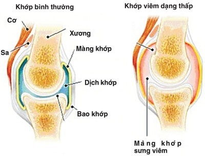Viêm khớp dạng thấp là bệnh bệnh lí về khớp thường gặp nhiều ở phụ nữ. 