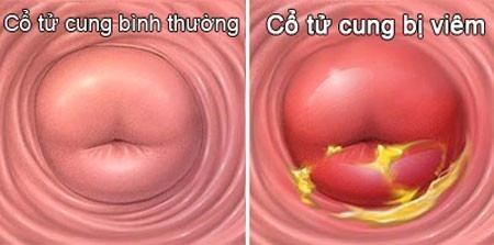Viêm cổ tử cung là bệnh lí phụ khoa thường gặp và khá phổ biến ở phụ nữ hiện đại.