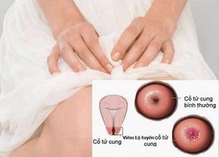 Viêm cổ tử cung hay các bệnh lí phụ khoa khác đều khiến người phụ nữ khó chịu và mất tự tin trong cuộc sống.