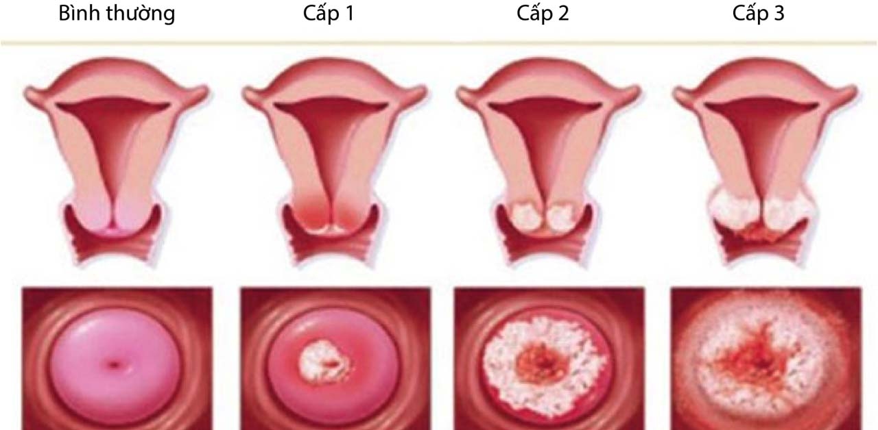 Cách xử trí viêm cổ tử cung lộ tuyến