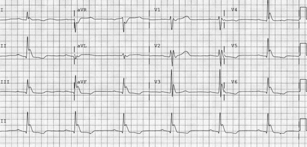 Điện tâm đồ là phương pháp giúp chẩn đoán chính xác bệnh rối loạn nhịp tim