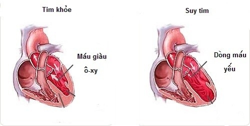 Suy tim tân trương là một trong những biến chứng của người cao huyết áp