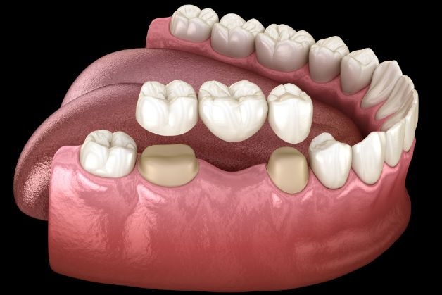 Kỹ thuật làm răng giả bằng cầu răng sứ