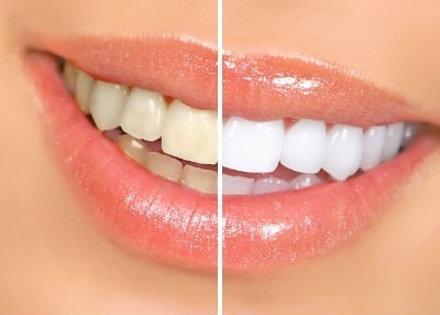 Tẩy trắng răng ở Bệnh viện Đa khoa Quốc tế Thu Cúc an toàn, hiệu quả