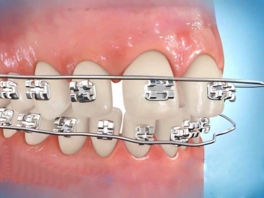 Thẩm mỹ răng thưa &#8211; Giải pháp tối ưu cho người răng thưa