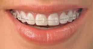 Niềng răng hiệu quả như thế nào? Có đẹp không?