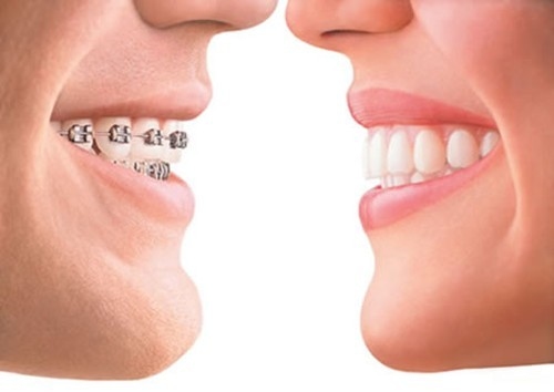 Niềng răng cho người lớn2