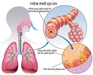 Hình ảnh giải phẫu bệnh viêm phế quản