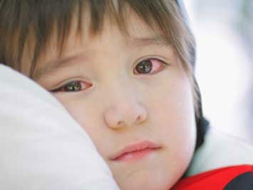 Các bệnh mắt ở trẻ em cần chú ý hơn