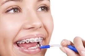 Niềng răng kiêng ăn gì? sự kiêng khem trong ăn uống