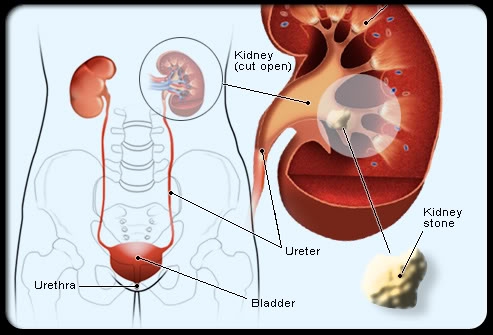 Sỏi thận có nguy hiểm không? phát hiện bị sỏi thận