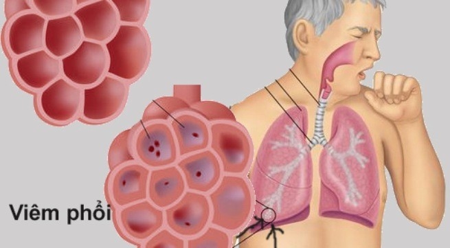 Viêm phổi có nguy hiểm không