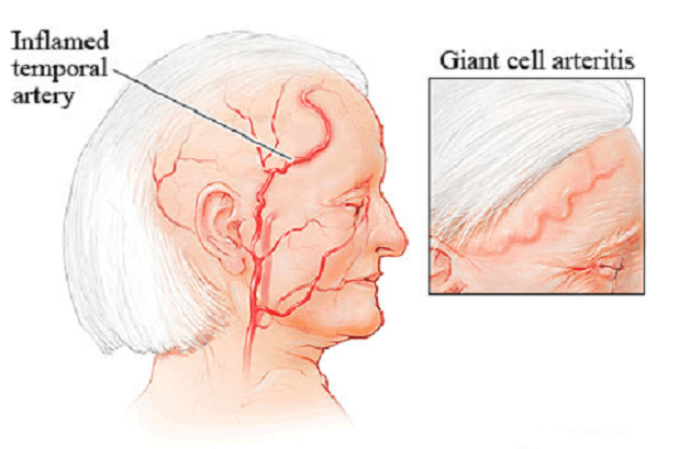 Viêm động mạch thái dương gây bệnh đau đầu ở người già
