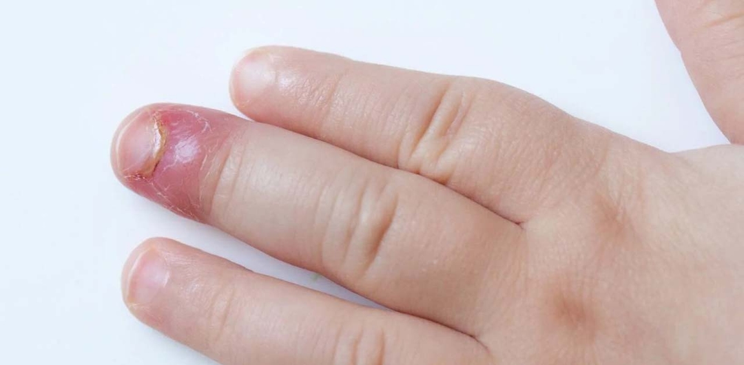 Đau đầu ngón tay cái là bệnh gì?