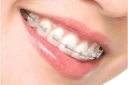 Niềng răng người lớn