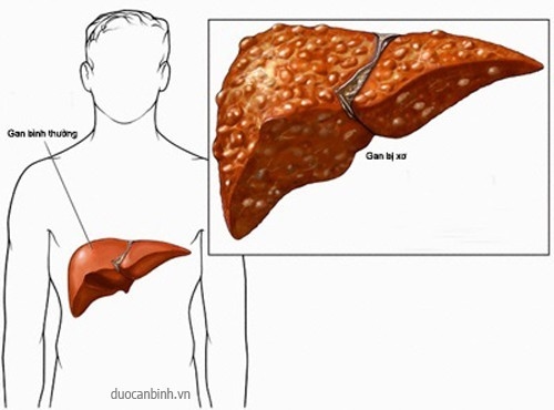 Xơ gan không được chữa trị có thể nguy hiểm đến tính mạng.
