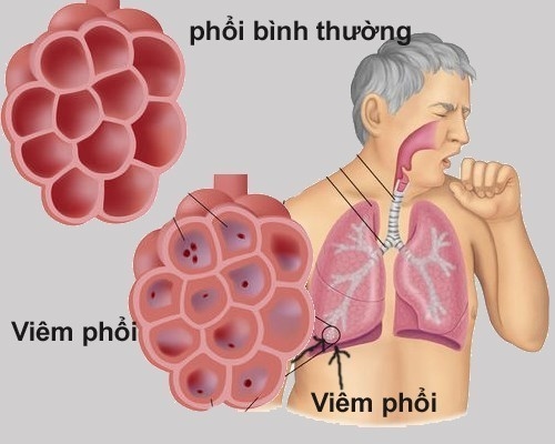 Bệnh viêm phổi ở người lớn triệu chứng của bệnh