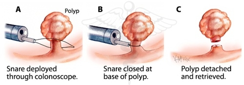 cắt polyp đại tràng