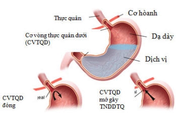 Hình ảnh mô tả về chứng trào ngược dạ dày