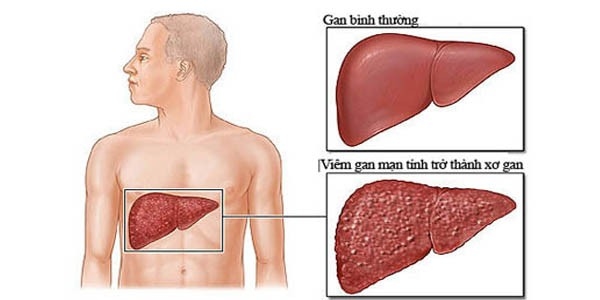 Bệnh xơ gan giai đoạn đầu xơ gan giai đoạn cuối