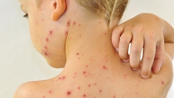 Người bị thủy đậu có nguy cơ mắc zona thần kinh cao hơn người bình thường