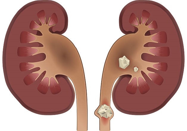 Địa chỉ tốt chữa sỏi thận - Căn bệnh phổ biến