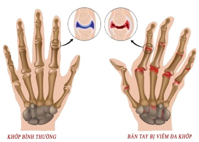 Điều trị viêm khớp dạng thấp như thế nào?
