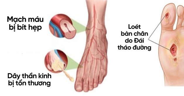 Bệnh tiểu đường - nguyên nhân gây đau dây thần kinh ngoại biên