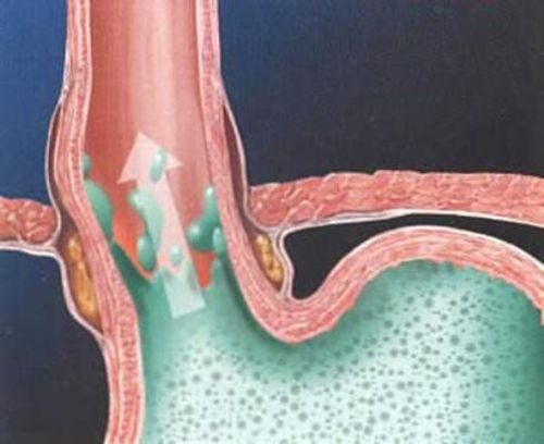 Chữa bệnh gerd &#8211; Hệ Thống Y Tế Thu Cúc
