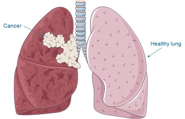 Ung thư phổi có di truyền không