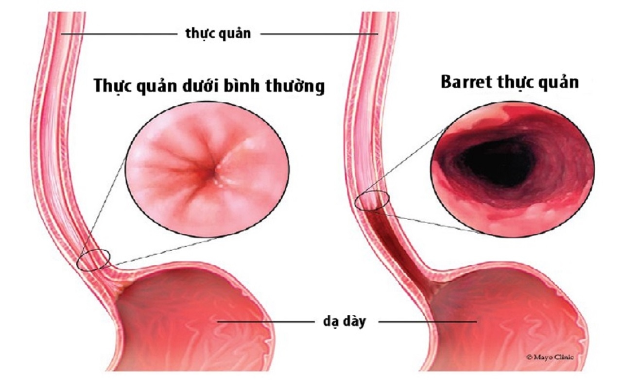 Điều trị barrett thực quản