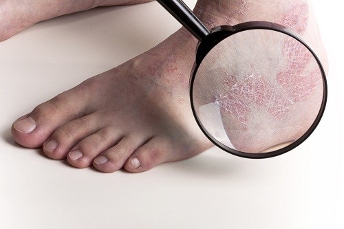 Bệnh vẩy nến ở trẻ em cũng là do di truyền và do vi khuẩn streptococcus và thường xảy ra sau nhiễm trùng cổ họng.
