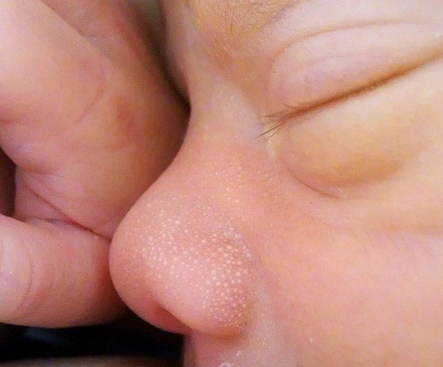 Mụn sữa là những nốt nhỏ li ti màu trắng ở trên trán, mặt, tay, chân của trẻ.