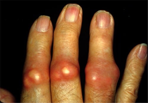 Chẩn đoán bệnh gout ở  bệnh viện Thu Cúc